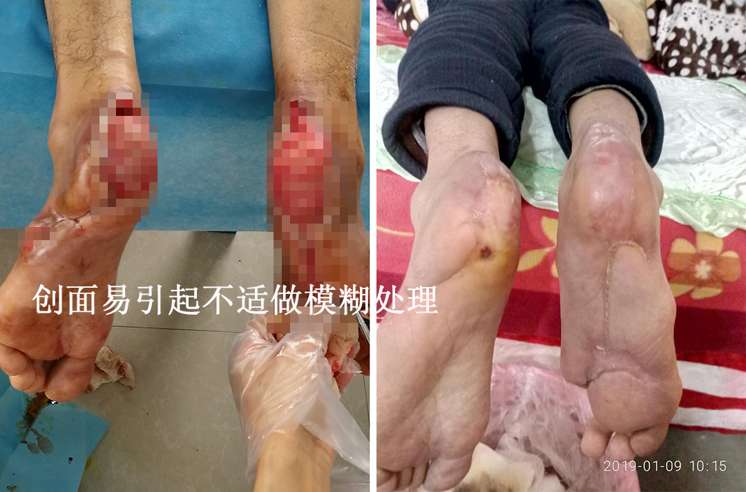 一个典型案例告诉大家，糖尿病足可以通过中西医开放式疗法保肢痊愈