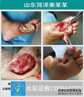 1523610002286062.jpg 四次截趾后不愈合.jpg